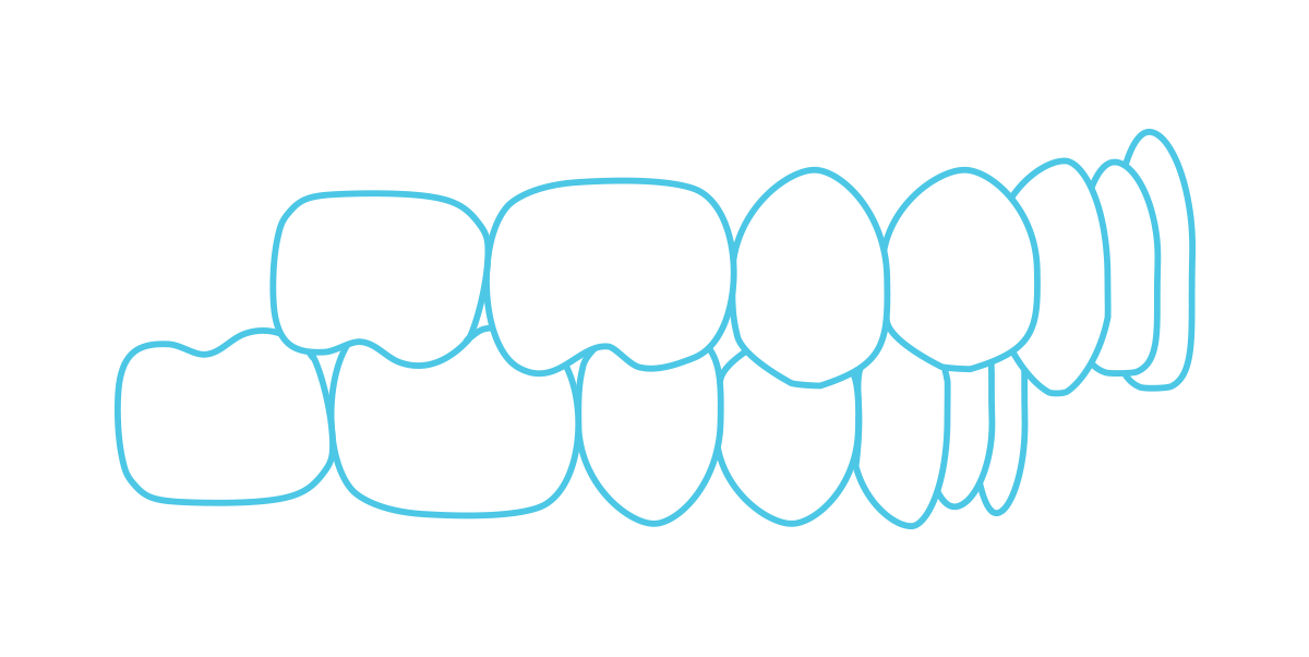 Overbite