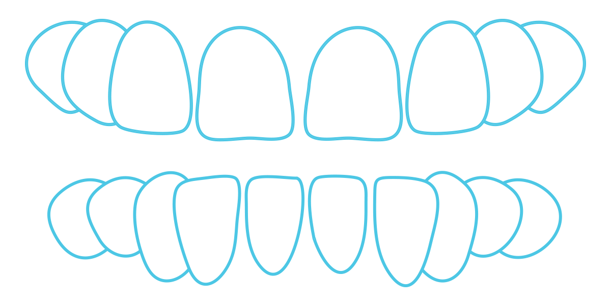 Gaps in Teeth