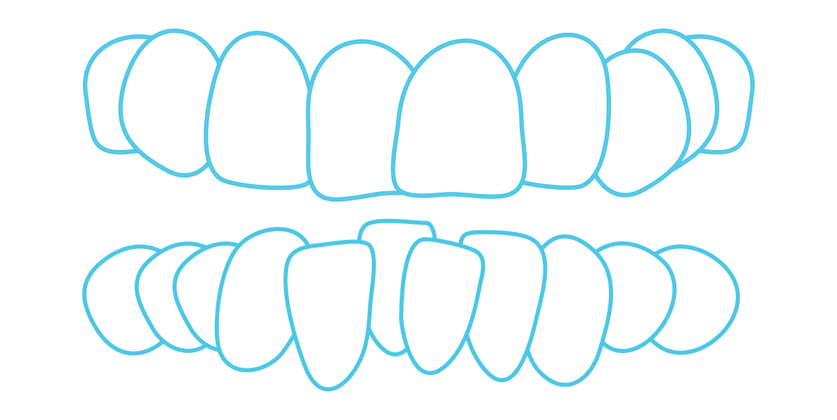 Crowded Teeth