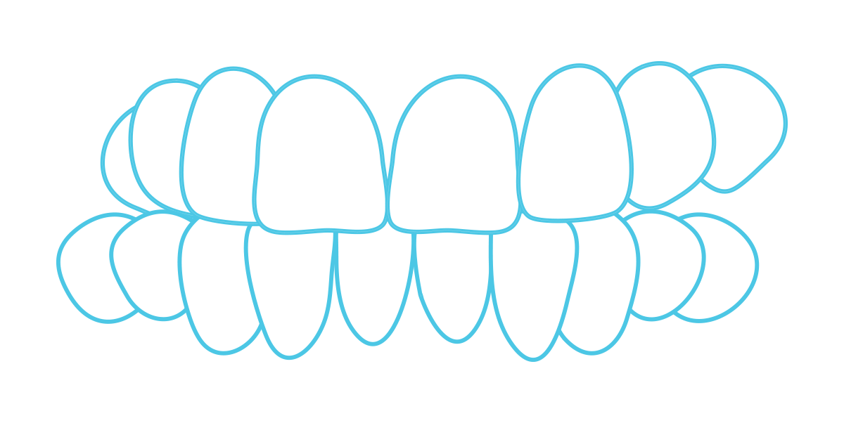 Crossbite