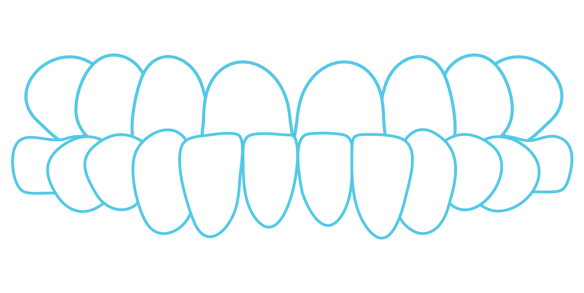 Underbite